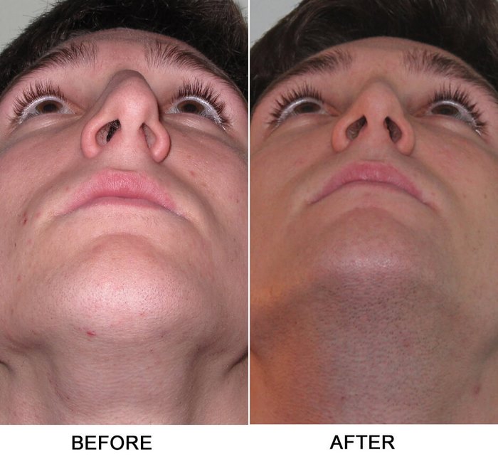 nasal-septum-deviated