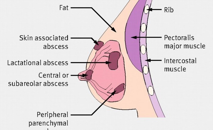 breast-abscess