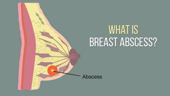 آبسه‌ پستان‌ چیست (علل، علائم، پیشگیری و درمان) breast abscess