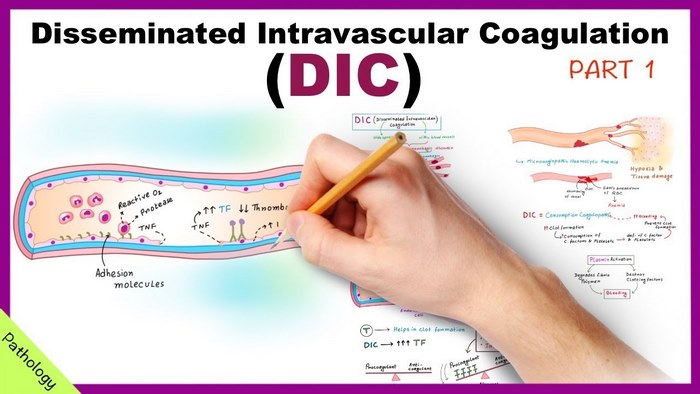 disseminated-intravascular-coagulation