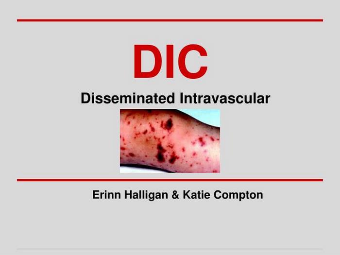 انعقاد داخل‌ عروق‌ منتشر چیست (علل، علائم، پیشگیری و درمان) disseminated intravascular coagulation
