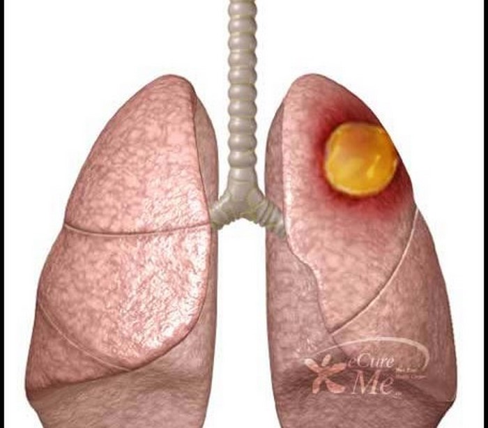 آبسه‌ ریه‌ چیست (علل، علائم، پیشگیری و درمان) lung abscess