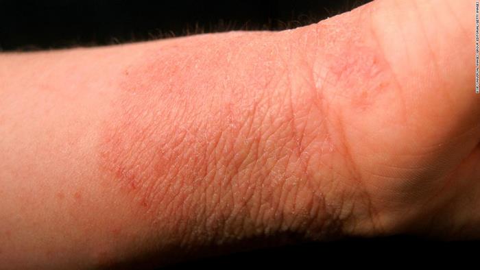 اگزما چیست (علل، علائم، پیشگیری و درمان) eczema