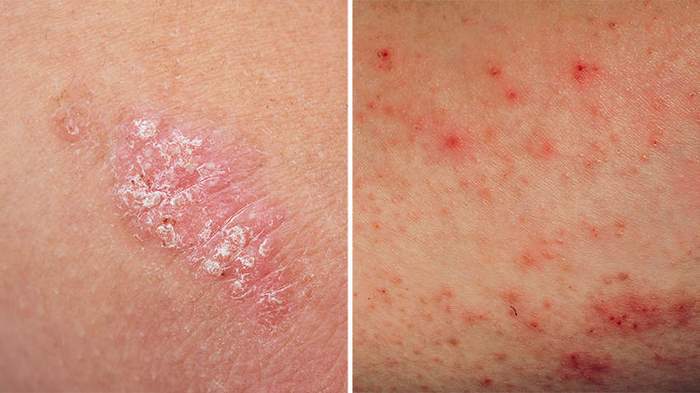 اگزما چیست (علل، علائم، پیشگیری و درمان) eczema