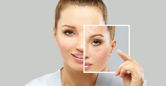 آکنه‌ چیست (جوشهای‌ غرور)(علل، علائم، پیشگیری و درمان) acne
