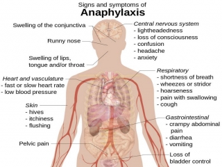 آنافیلاکسی‌ چیست (شوک‌ آلرژیک‌)(علل، علائم، پیشگیری و درمان) anaphylaxis