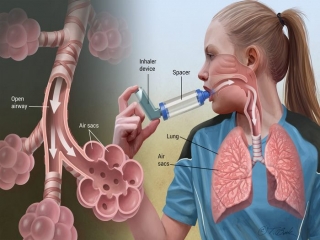 آسم‌ چیست (علل، علائم، پیشگیری و درمان) asthma
