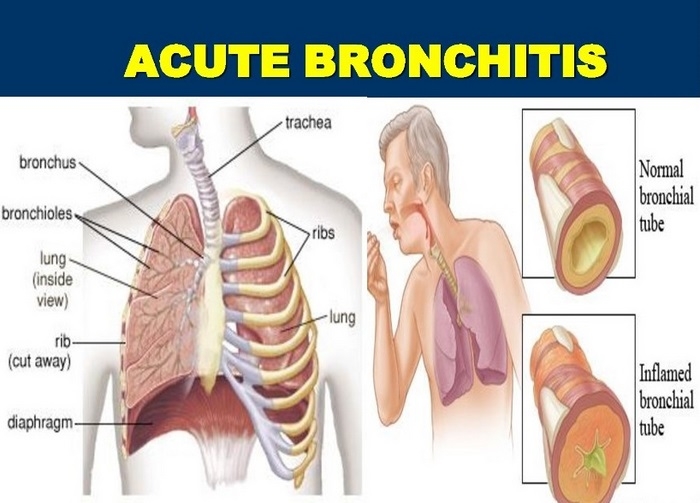 برونشیت‌ حاد چیست (علل، علائم، پیشگیری و درمان) bronchitis acute