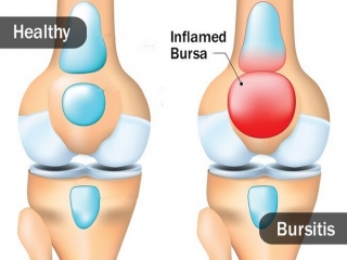 بورسیت‌ چیست (علل، علائم، پیشگیری و درمان) bursitis