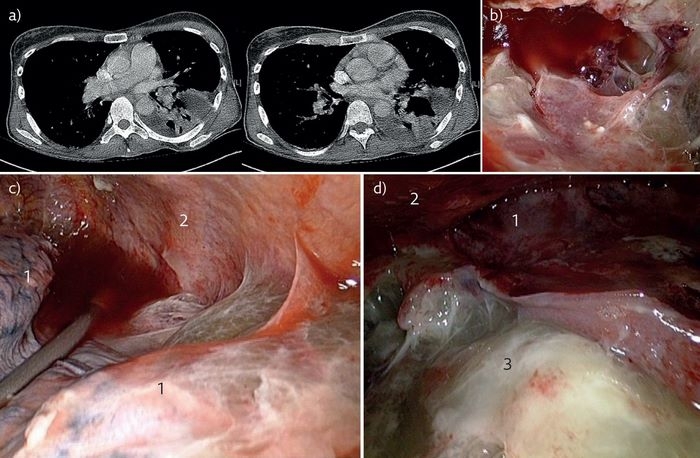 آمپیم‌ چیست (علل، علائم، پیشگیری و درمان) empyema