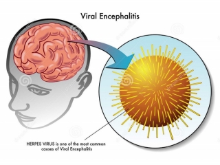 آنسفالیت‌ ویروسی‌ چیست (علل، علائم، پیشگیری و درمان) encephalitis viral