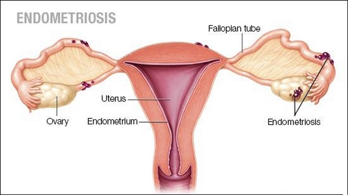 آندومتریوز چیست (علل، علائم، پیشگیری و درمان) endometriosis