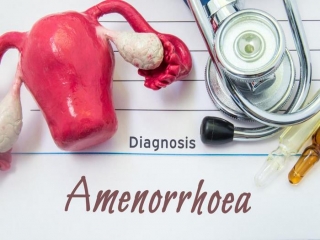 آمنوره‌ اولیه‌ چیست (علل، علائم، پیشگیری و درمان) amenorrhea primary