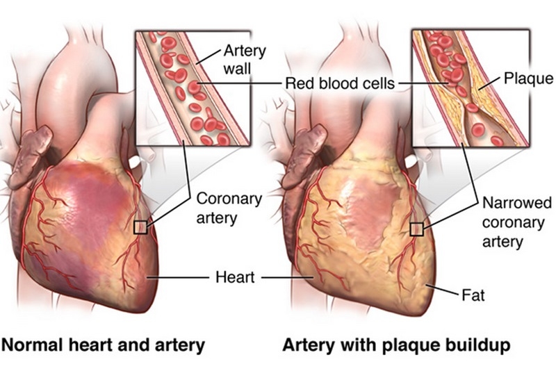 سرخرگ‌های‌ قلب چیست (علل، علائم، پیشگیری و درمان) coronary artery disease