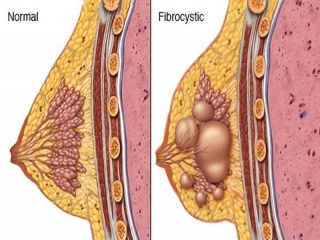 فیبروکیستیک‌ پستان‌ چیست (علل، علائم، پیشگیری و درمان) fibrocystic breast disease