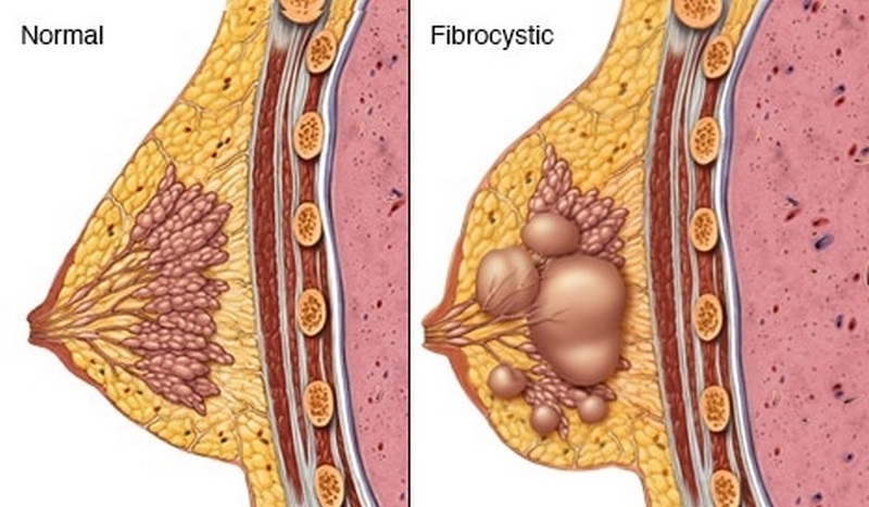 فیبروکیستیک پستان چیست (علل، علائم، پیشگیری و درمان) fibrocystic breast disease