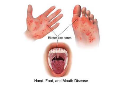 بیماری دست و پا و دهان چیست (علل، علائم، پیشگیری و درمان) hand foot and mouth disease