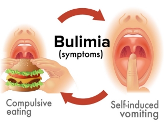 بولیمی‌ چیست (علل، علائم، پیشگیری و درمان) bulimia