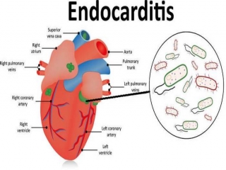 آندوکاردیت‌ چیست (علل، علائم، پیشگیری و درمان) endocarditis