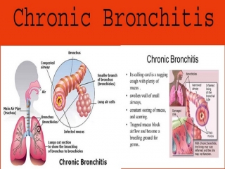 برونشیت‌ مزمن چیست (علل، علائم، پیشگیری و درمان) bronchitis chronic