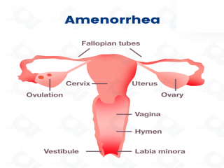 آمنوره‌ ثانویه‌ چیست (علل، علائم، پیشگیری و درمان) amenorrhea secondary