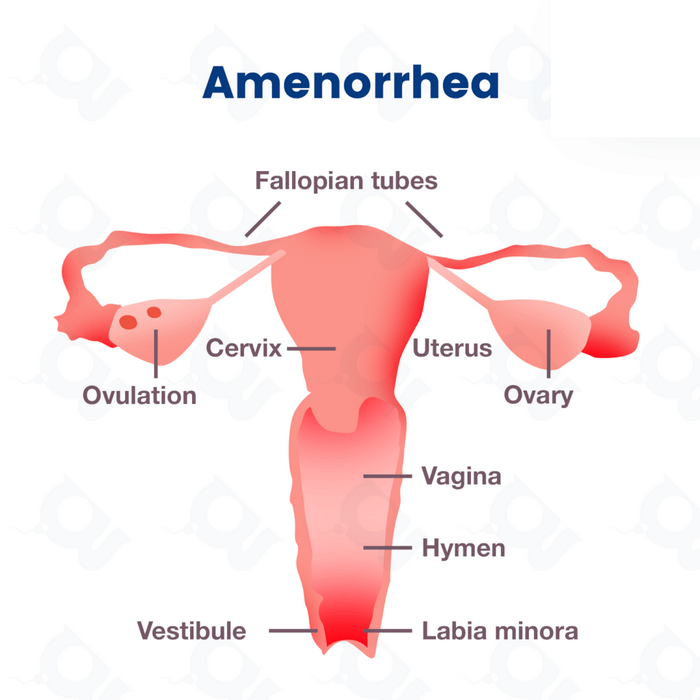 آمنوره ثانویه چیست (علل، علائم، پیشگیری و درمان) amenorrhea secondary آمنوره ثانویه چیست (علل، علائم، پیشگیری و درمان) amenorrhea secondary