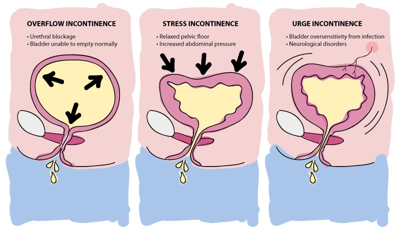 بی‌ اختیاری‌ ادرار فوریتی چیست (علل، علائم، پیشگیری و درمان) incontinence urge