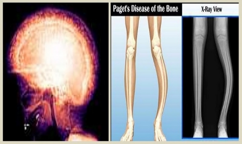 پاژه‌ استخوان چیست (علل، علائم، پیشگیری و درمان) paget's disease of bone