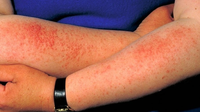 آفتاب زدگی‌ چیست (علل، علائم، پیشگیری و درمان) sun poisoning