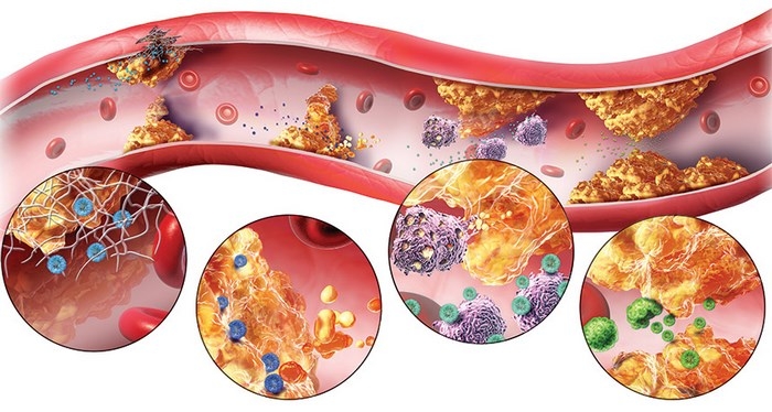 آترواسکلروز یا تصلب‌ شرایین‌ چیست (علل، علائم، پیشگیری و درمان) atherosclerosis