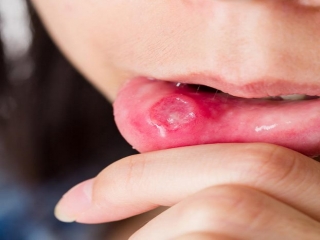 آفت دهان چیست (علل، علائم، پیشگیری و درمان) canker sores