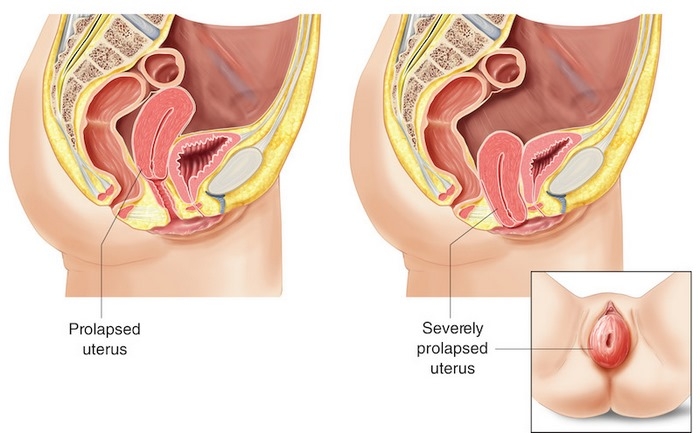 بیرون زدگی‌ رحم چیست (علل، علائم، پیشگیری و درمان) uterine prolapse
