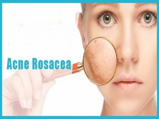 آکنه‌ روزاسه‌ چیست (علل، علائم، پیشگیری و درمان) acne rosacea