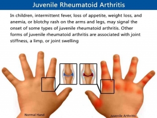 آرتریت‌ روماتویید کودکان چیست (علل، علائم، پیشگیری و درمان) arthritis juvenile rheumatoid