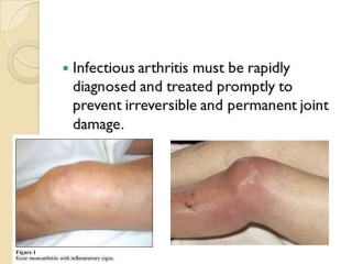 آرتریت‌ عفونی‌ چیست (علل، علائم، پیشگیری و درمان) arthritis infectious