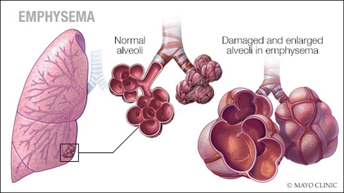آمفیزم‌ چیست (علل، علائم، پیشگیری و درمان) emphysema