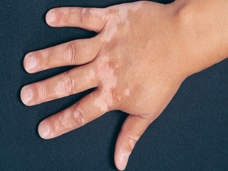برجس‌ چیست (علل، علائم، پیشگیری و درمان) vitiligo
