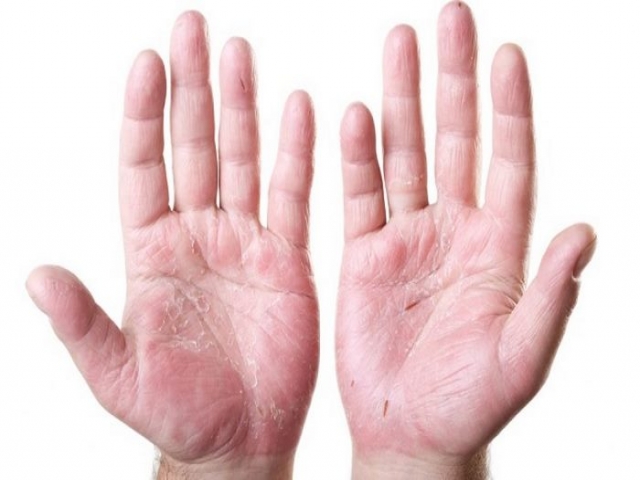 آرتریت مرتبط با پسوریازیس چیست (علل، علائم، پیشگیری و درمان) psoriatic arthritis آرتریت مرتبط با پسوریازیس چیست (علل، علائم، پیشگیری و درمان) psoriatic arthritis