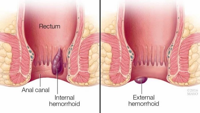 بواسیر چیست (علل، علائم، پیشگیری و درمان) hemorrhoids