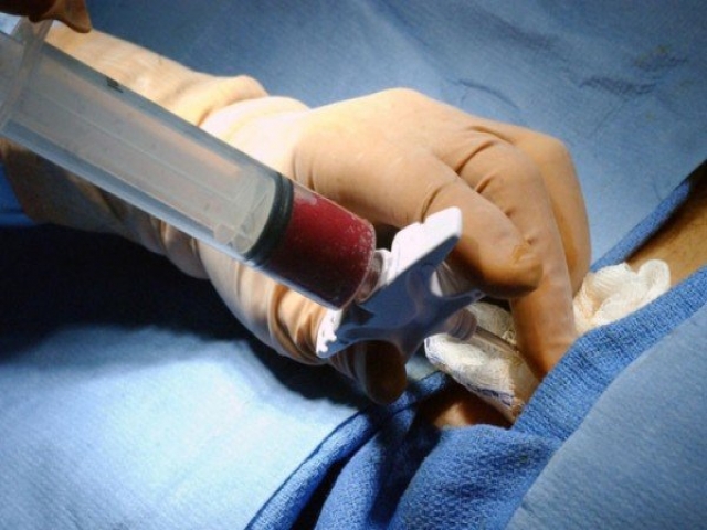 انجام موفقیتآمیز اولین پیوند مغز استخوان در بیمار مبتلا به HIV انجام موفقیتآمیز اولین پیوند مغز استخوان در بیمار مبتلا به HIV