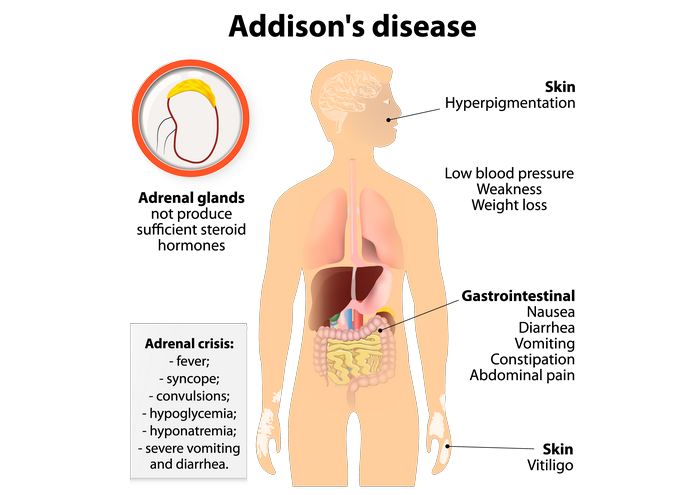 آدیسون‌ چیست (علل، علائم، پیشگیری و درمان) addison's disease