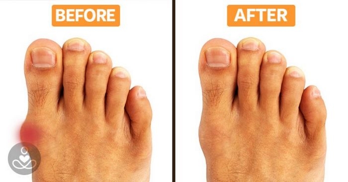 بونیون چیست (علل، علائم، پیشگیری و درمان) bunion