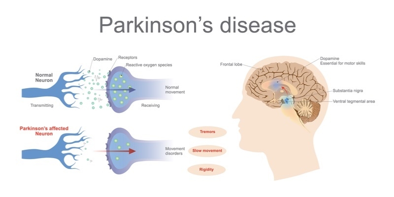 پارکینسون‌ چیست (علل، علائم، پیشگیری و درمان) parkinson's disease