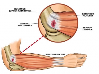 آرنج‌ تنیس‌بازان چیست (علل، علائم، پیشگیری و درمان) tennis elbow