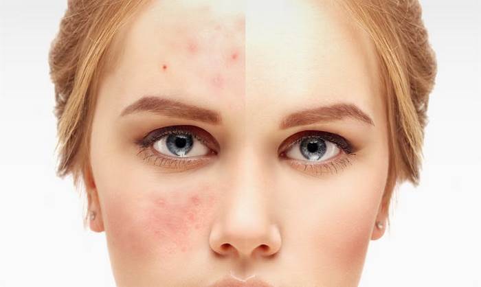 آکنه‌ چیست (جوشهای‌ غرور)(علل، علائم، پیشگیری و درمان) acne