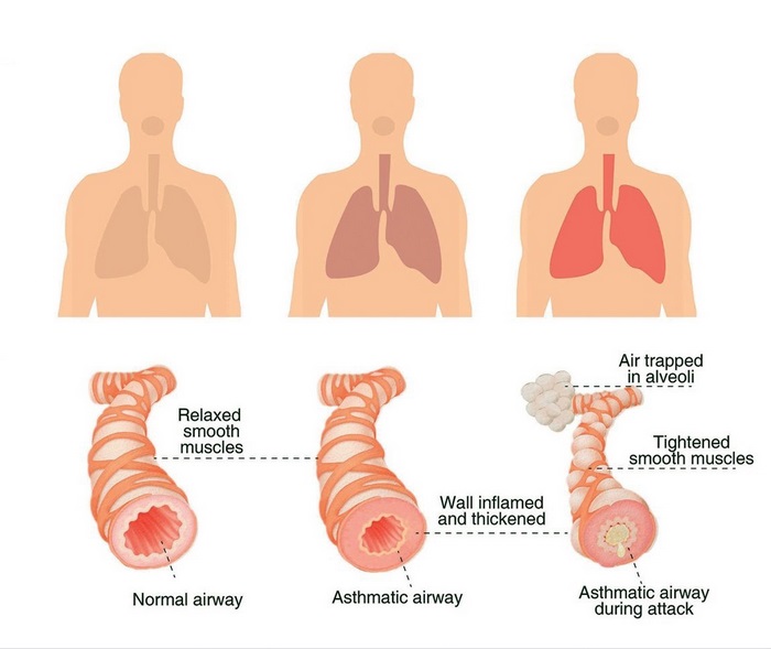 آسم‌ چیست (علل، علائم، پیشگیری و درمان) asthma