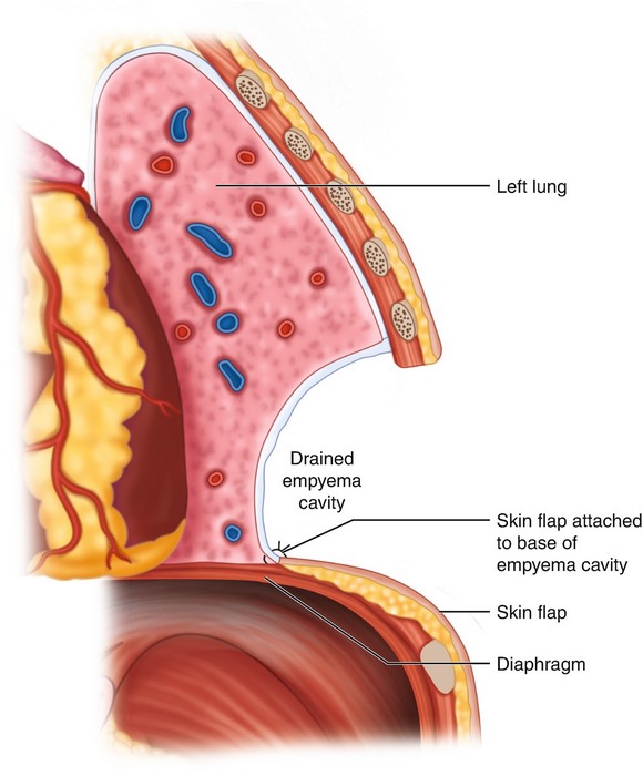 empyema