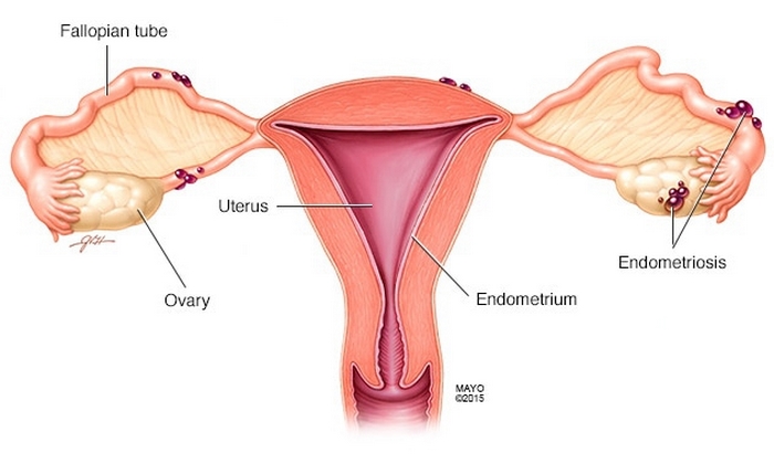 آندومتریوز چیست (علل، علائم، پیشگیری و درمان) endometriosis