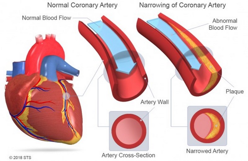 coronary-artery-disease