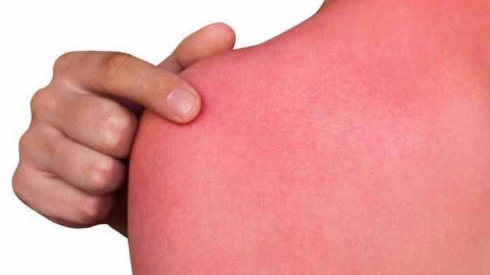 آفتاب سوختگی چیست (علل، علائم، پیشگیری و درمان) sunburn